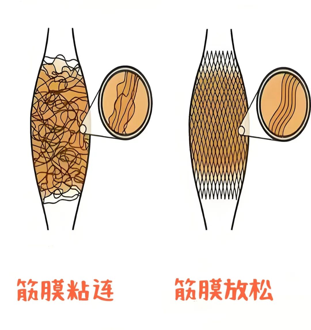 为什么肌筋膜会粘连？